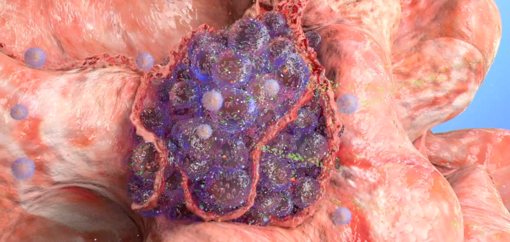 Cancer development medical video cancer development medical video