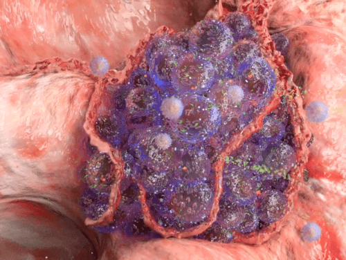 Cancer development medical video cancer development medical video